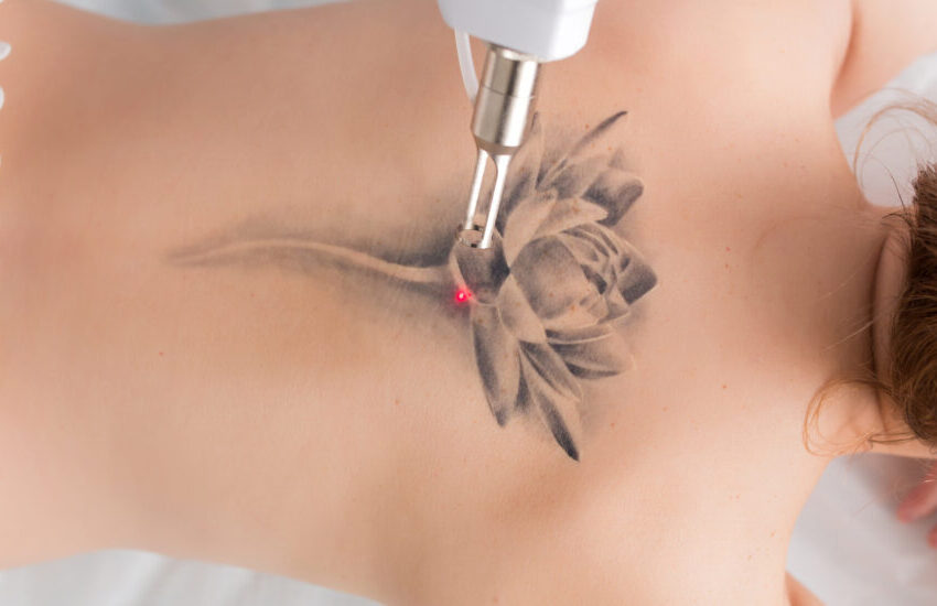  Remoção de tatuagens cresce e evolui suas técnicas