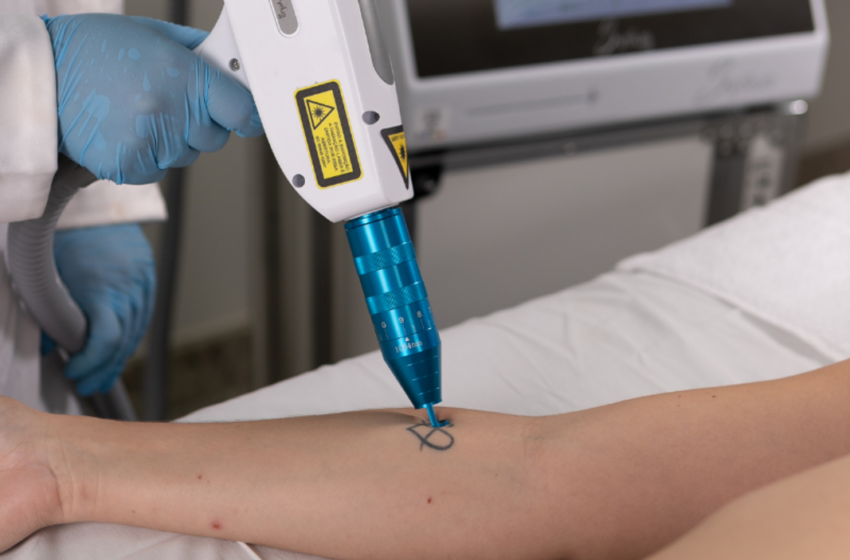 Procura por remoção de tatuagens cresce no Brasil